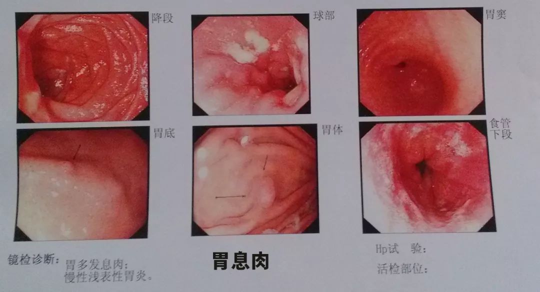 肠息肉、胃息肉、胆息肉、鼻息肉到底哪个该切除？-第3张图片-牧野网