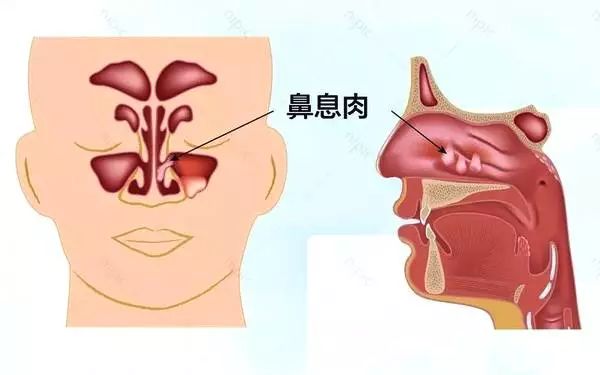 肠息肉、胃息肉、胆息肉、鼻息肉到底哪个该切除？-第7张图片-牧野网