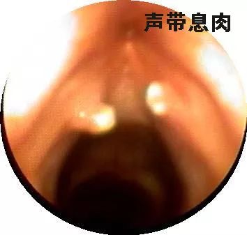 肠息肉、胃息肉、胆息肉、鼻息肉到底哪个该切除？-第11张图片-牧野网