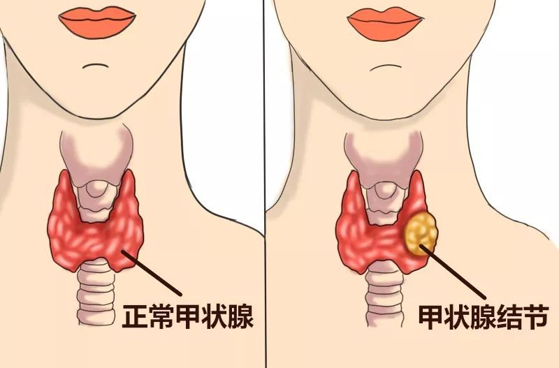 甲状腺出现问题还可以买商业保险吗-第3张图片-牧野网